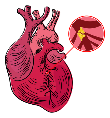 Atherosclerosis Disease  Illustration