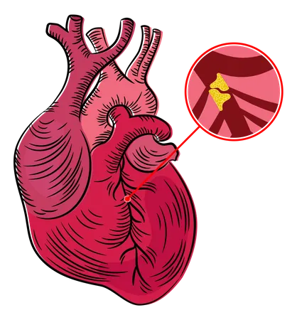 Atherosclerosis Disease  Illustration