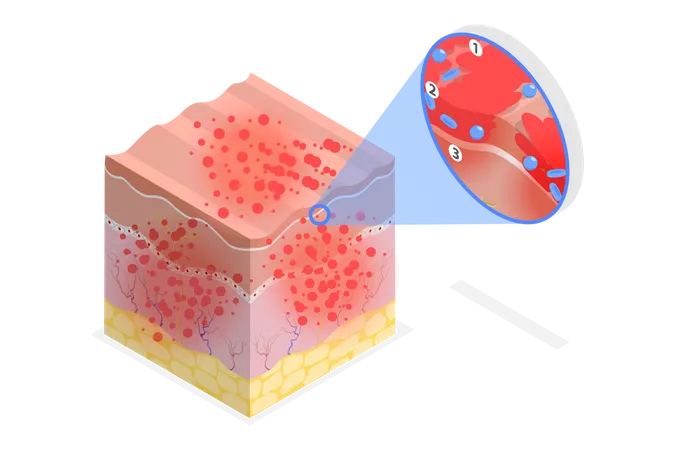 3 D Isometric Flat Vector Conceptual Illustration Of Atopic Dermatitis Eczema Symptoms Illustration