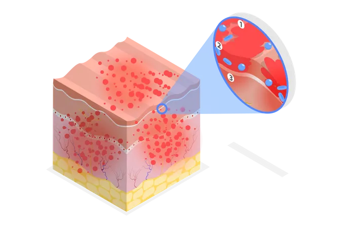 Atopic Dermatitis  Illustration