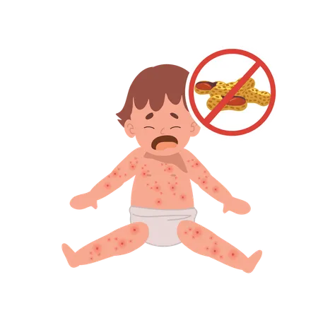 Allergic Reactions In Infants Baby With Skin Rash Baby Food Allergy From Peanut Peanut Sensitivity Illustration