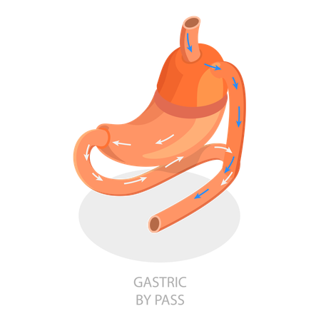 Bariatric Surgery  Illustration