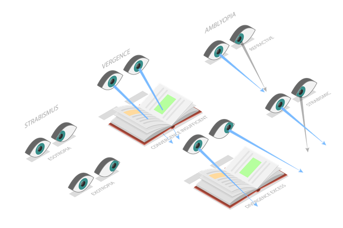 Binocular Vision Disorders and Medical Sight Health Problems  Illustration