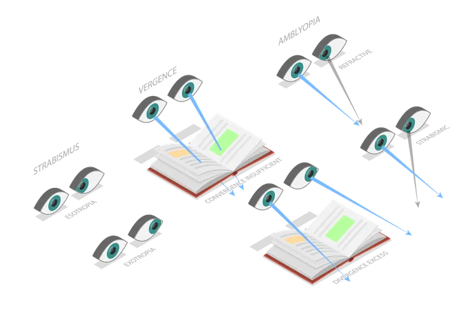 Binocular Vision Disorders and Medical Sight Health Problems  Illustration