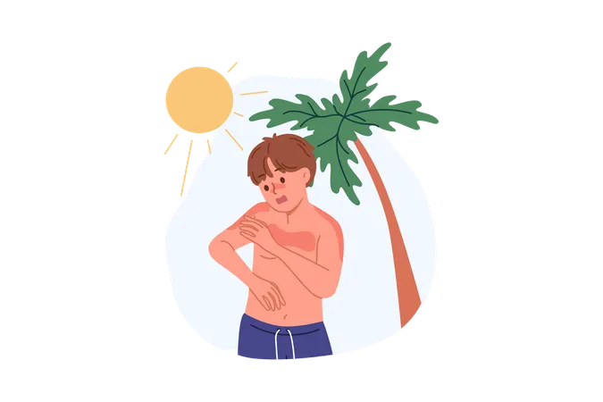 Boy Received Sunburn Due To Ultraviolet Allergy Or Heliophobia Standing On Beach With Palm Tree Lack Of Sunscreen Caused Sunburn In Child Requiring Medical Attention Or Medicinal Ointment Illustration