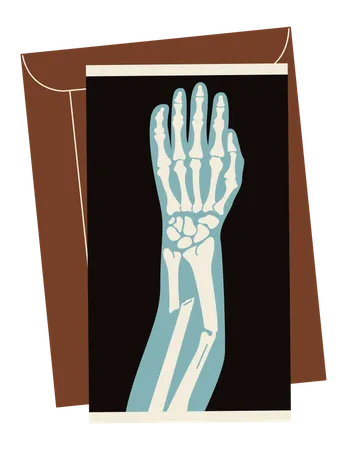 Broken arm x-ray  Illustration