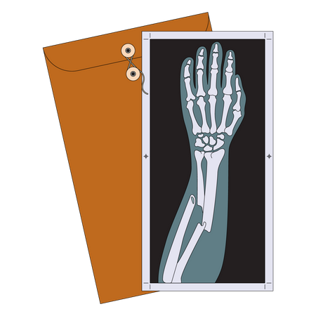 Broken arm X-ray Illustration