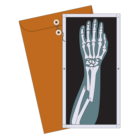 Broken arm X-ray  Illustration