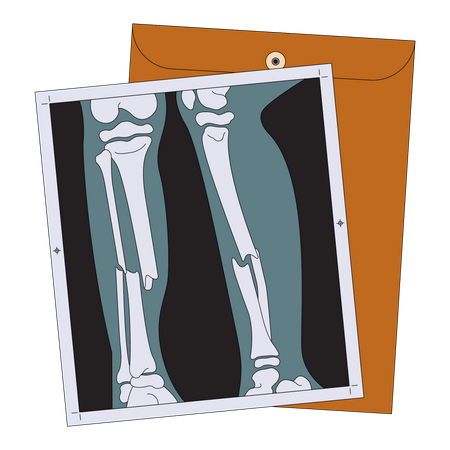 Broken leg x ray  Illustration