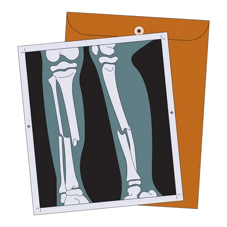 Broken leg x ray  Illustration