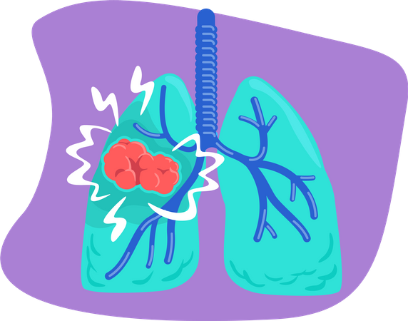 Cáncer de pulmón  Ilustración