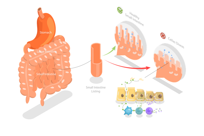 Celiac Disease  Illustration