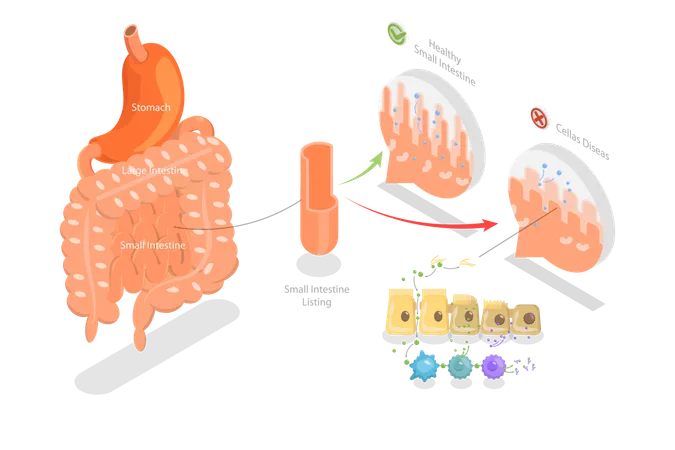 Celiac Disease  Illustration