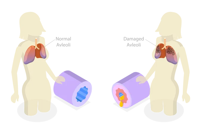 Chronic Obstructive Pulmonary Disease  Illustration