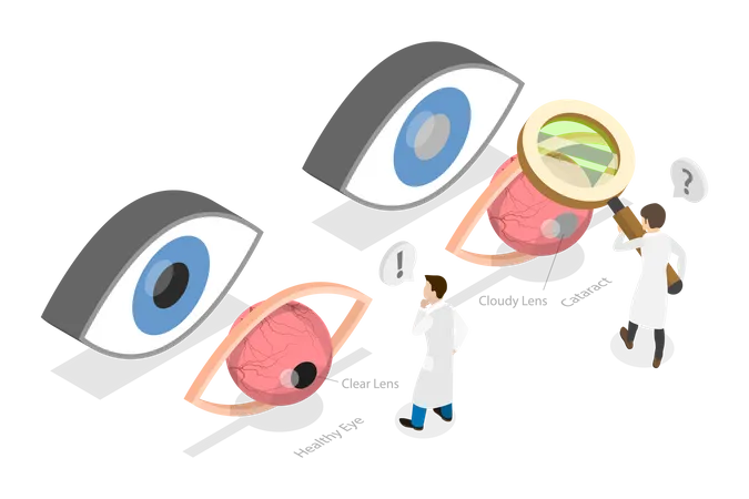 Ilustracion Conceptual De Vector Plano Isometrico 3 D De Cataratas Oftalmologia Cirugia Ocular Ilustración
