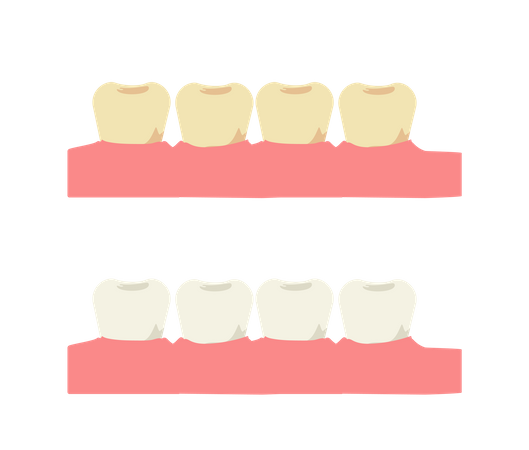 Clareamento dental e dente com placa amarela antes  Ilustração