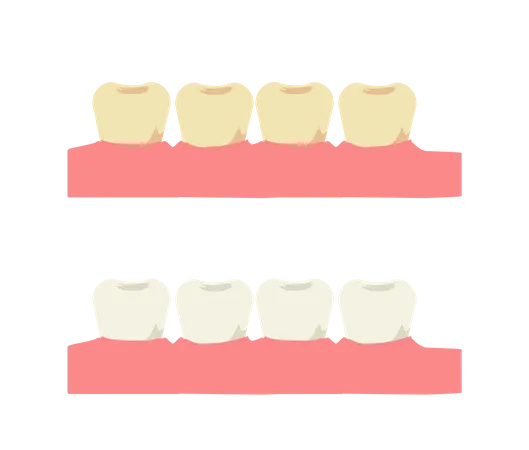 Clareamento dental e dente com placa amarela antes  Ilustração