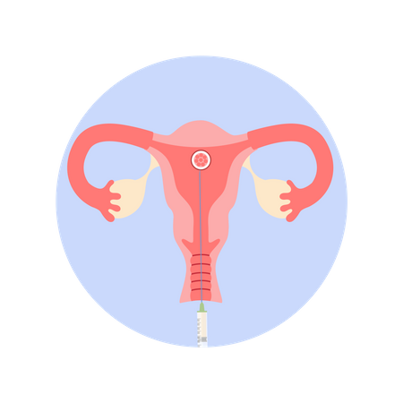 Colocando o embrião no útero da mulher  Ilustração