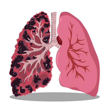 Comparison of Healthy Lungs and Smoker's Lungs  Illustration