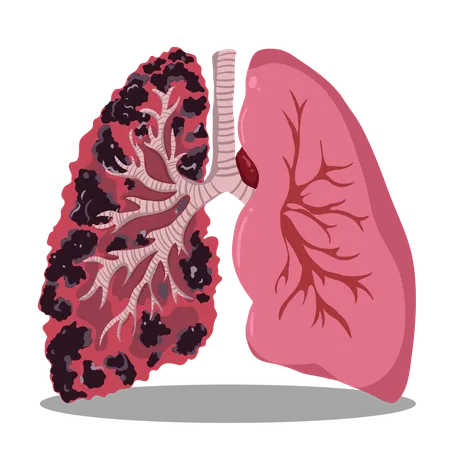 Comparison of Healthy Lungs and Smoker's Lungs  Illustration