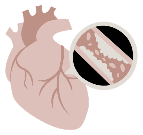 Coronary artery disease  Illustration