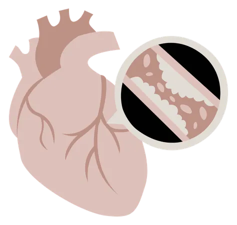 Coronary artery disease  Illustration