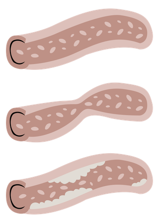 Coronary artery  Illustration