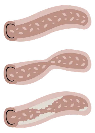 Coronary artery  Illustration