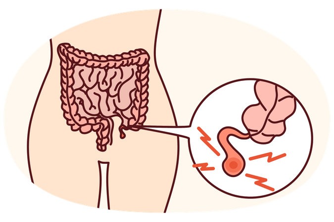 Corpo humano com apendicite inflamada  Ilustração