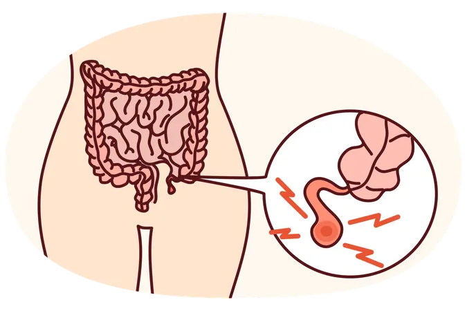Corpo humano com apendicite inflamada  Ilustração