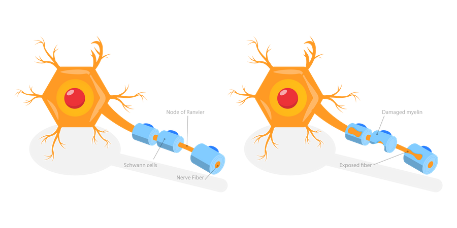 Demyelinating Disease  Illustration