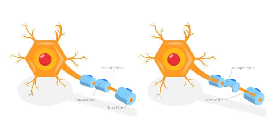 Demyelinating Disease  Illustration