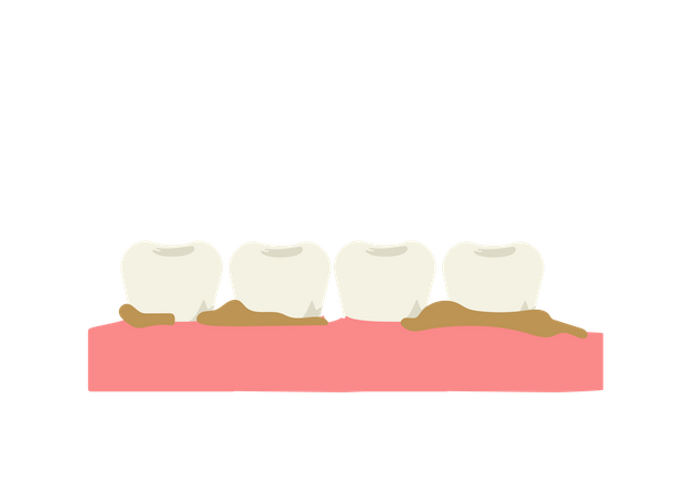 Dentes com placa bacteriana e tártaro  Ilustração