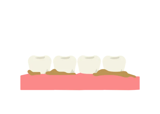 Dentes com placa bacteriana e tártaro  Ilustração