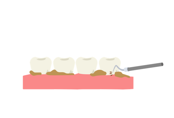 Détartrage des dents à l'aide d'un outil dentaire  Illustration