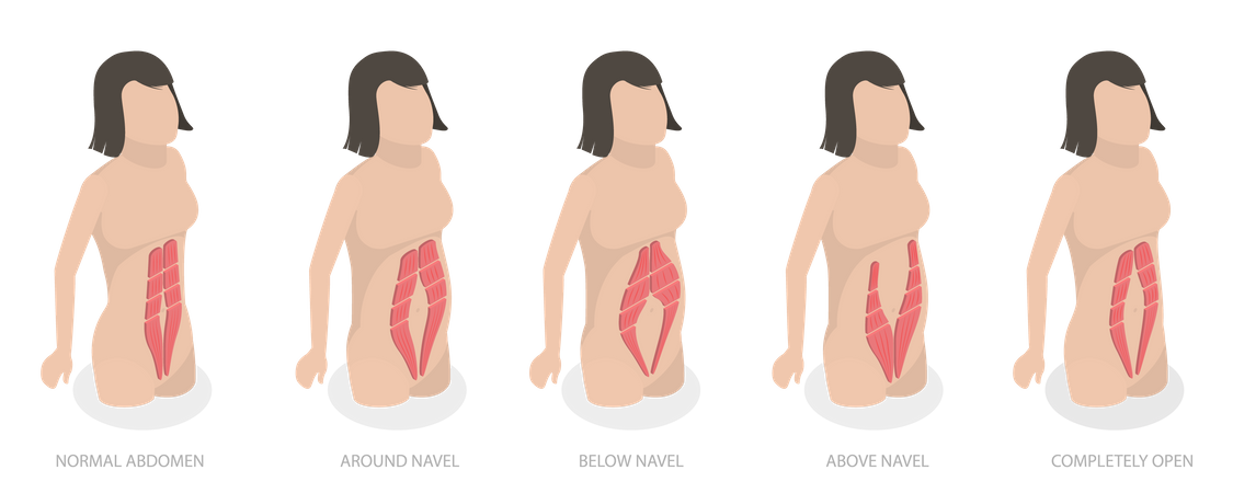 Diastase musculaire abdominale et problème chez les femmes après la grossesse  Illustration