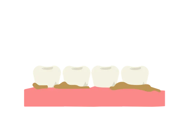 Dientes con placa y sarro  Ilustración