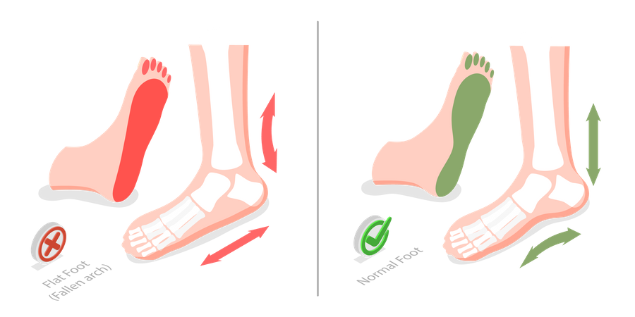 Diferencia entre pies enfermos y sanos  Ilustración