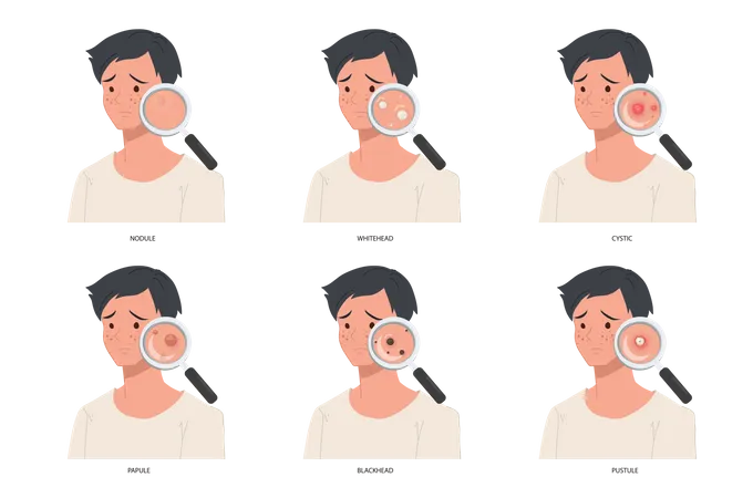 Diferentes tipos de acne grave no rosto masculino  Ilustração