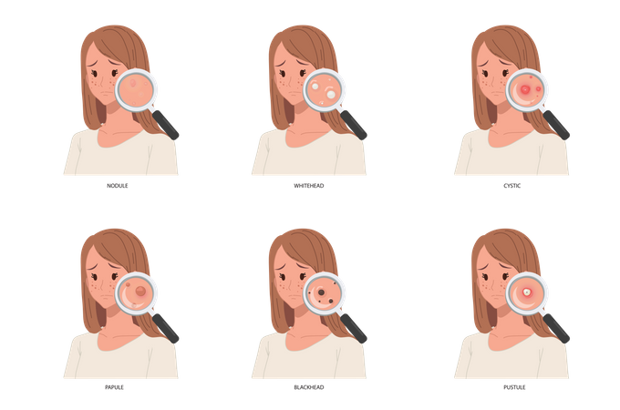 Diferentes tipos de problemas de acne  Ilustração