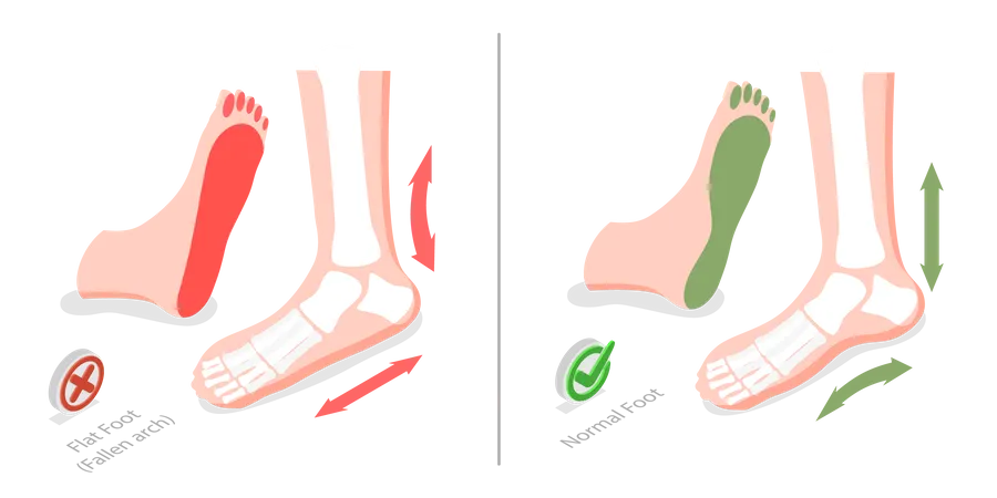 3 D Isometric Flat Vector Conceptual Illustration Of Flat Foot Difference Between Sick And Healthy Feet Illustration