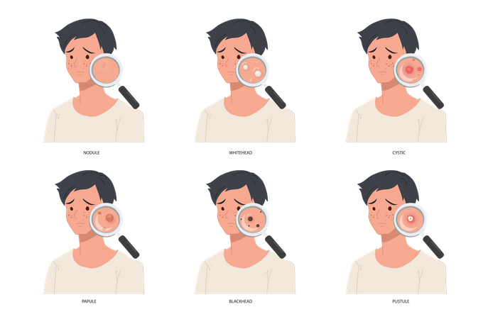 Different types of severe male face acne Illustration