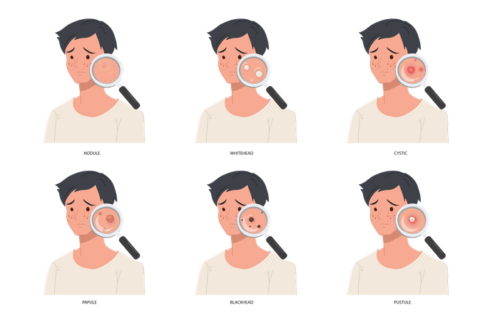 Différents types d’acné sévère du visage masculin  Illustration