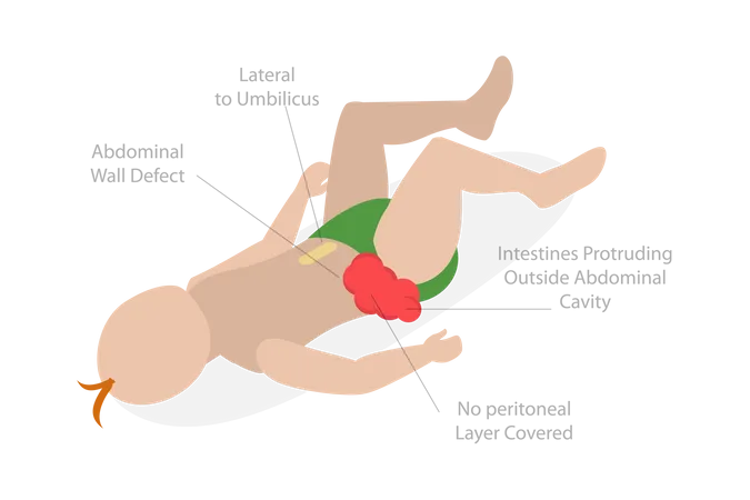 Dolor abdominal ombligo  Ilustración