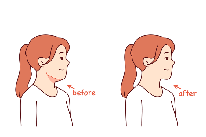 Double chin removal surgery for young girl posing before and after procedure with cosmetologist  Illustration