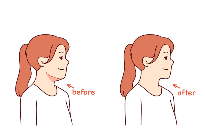 Double chin removal surgery for young girl posing before and after procedure with cosmetologist  Illustration