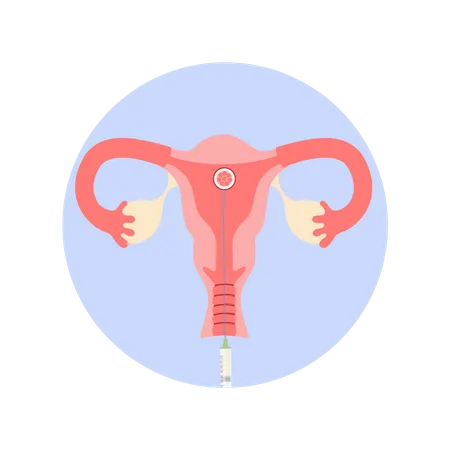 In Vitro Fertilisationsschritt Embryo In Die Gebarmutter Einer Frau Legen Kunstliche Schwangerschaft Mit Hilfe Moderner Technologie Isolierte Abbildung Illustration