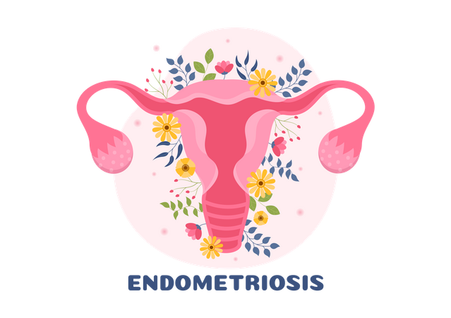 Endometriosis Illustration