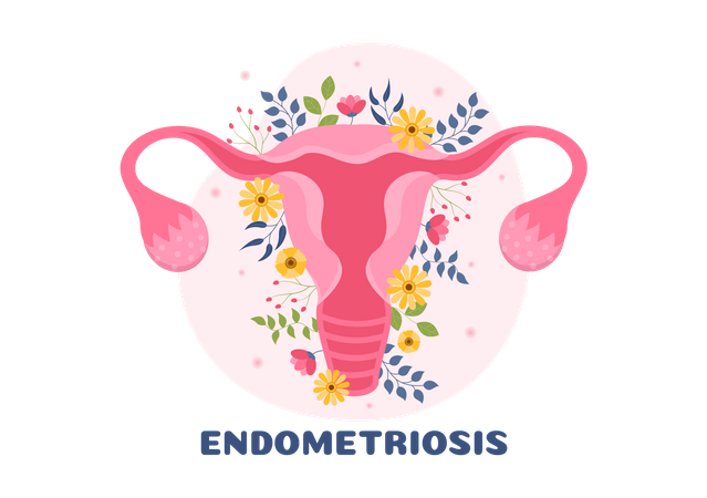 Endometriosis  Illustration