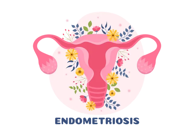 Endometriosis  Illustration